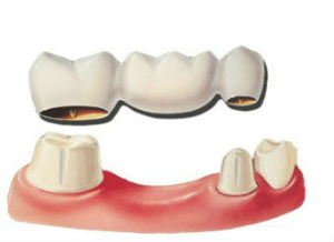 Dr. Turnage | Dental Bridges | Spartanburg SC Dentist