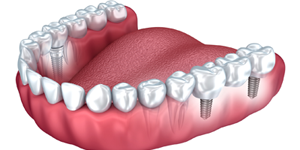 Replace several or all teeth with Dental Implants Gaffney, SC